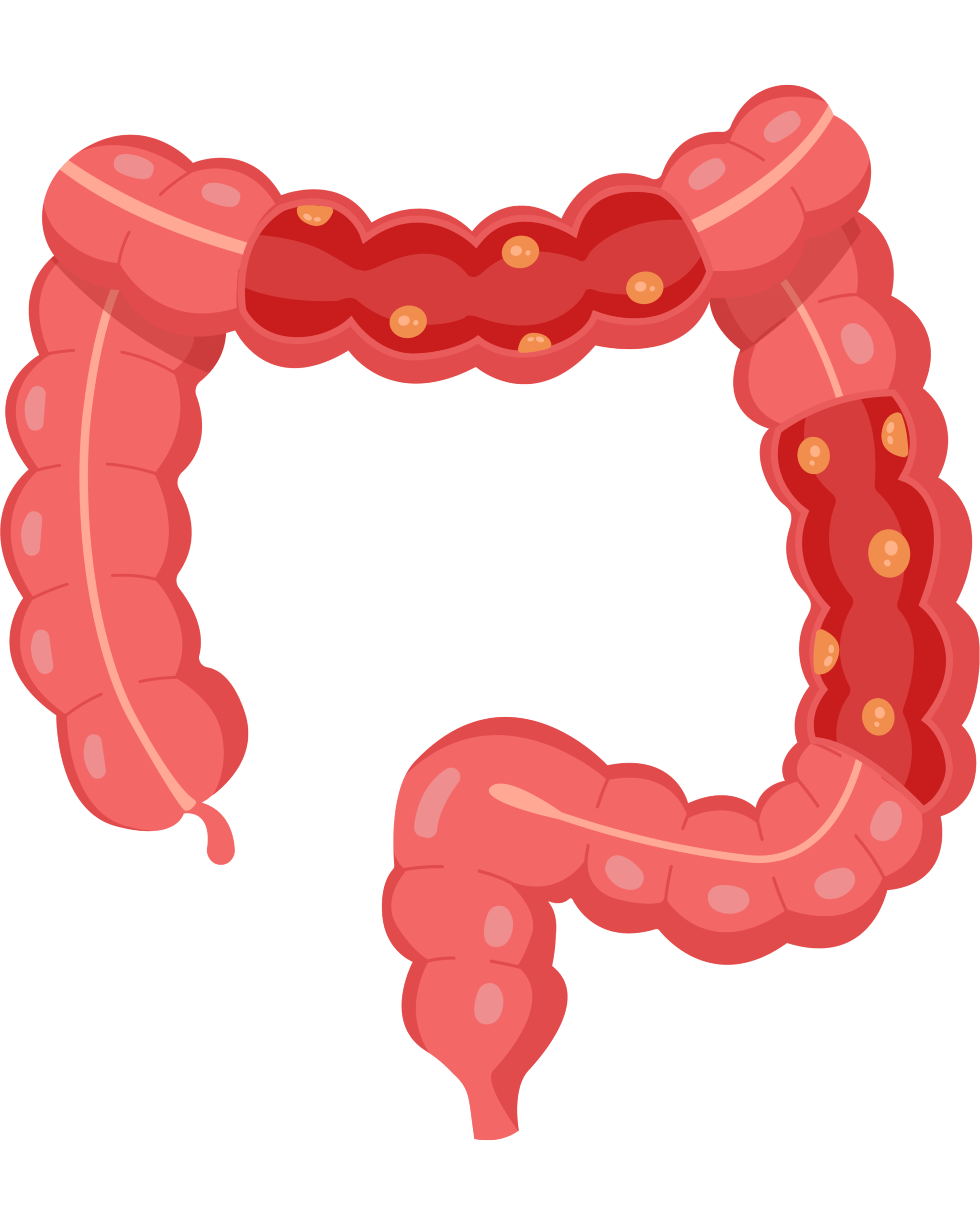 Nutrición clínica y digestivo 5 Tratamiento nutricional enfermedad inflamatoria intestinal crohn colitis ulcerosa
